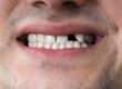 a man smiles with a missing tooth displaying signs of meth mouth