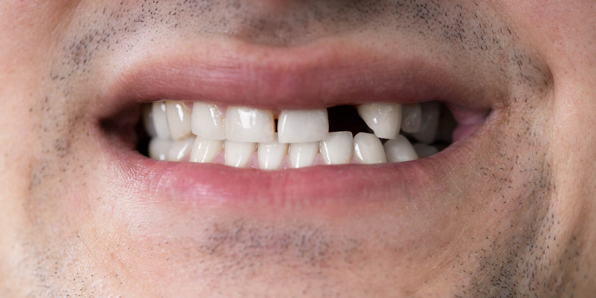 What Is Meth Mouth Teeth Loss After Meth Addiction a man smiles with a missing tooth displaying signs of meth mouth