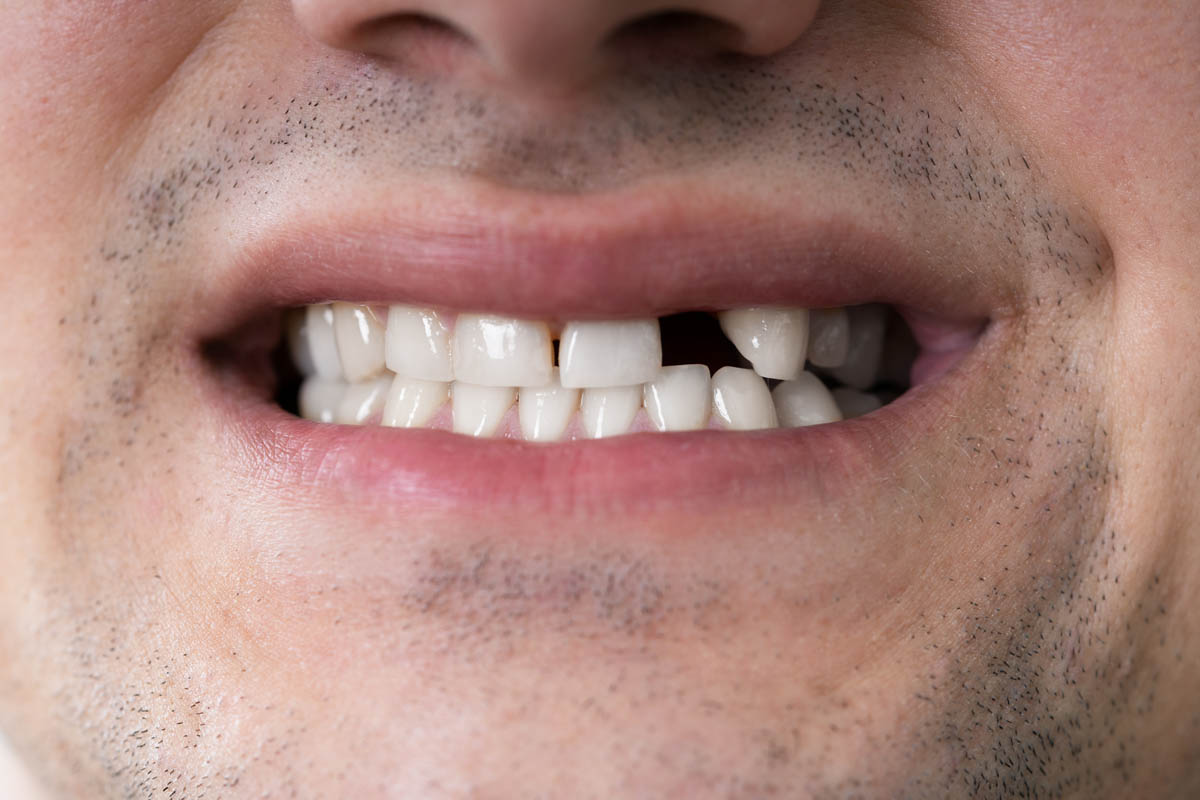 What Is Meth Mouth Teeth Loss After Meth Addiction a man smiles with a missing tooth displaying signs of meth mouth